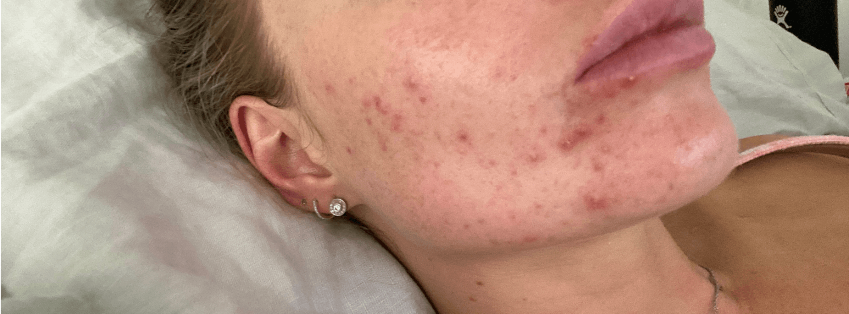Skincare not helping your breakouts? Try this