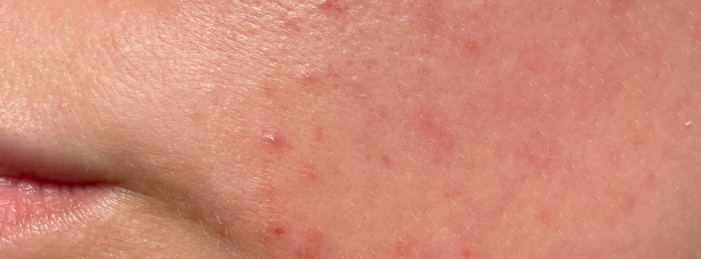 Hormonal acne basics